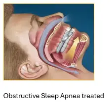 a graphic image of treated obstructive sleep apnea