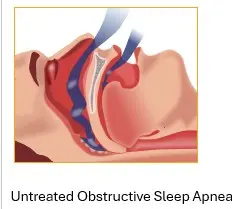 a graphic image of untreated obstructive sleep apnea