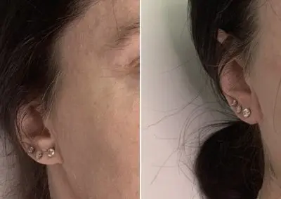 A before & after picture of bio-filler injected to ear lope to address aging, creases and uneven piercings.