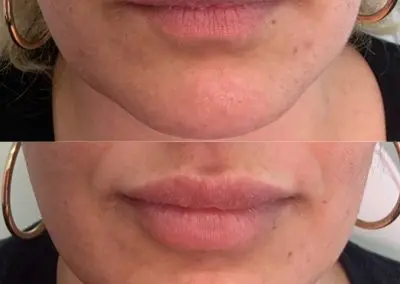 Traditional Lip Filler