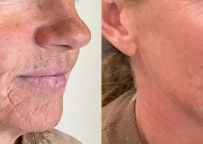 Older woman with significant lines around mouth from aging and smoking. The after results show significant reduction in lines after using Radiesse Gold