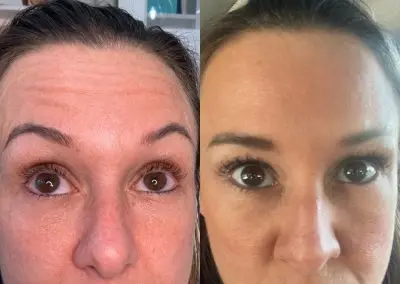 Southern Grace Aesthetics Client before and after botox picture showing natural results