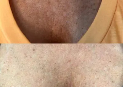 Before & After Older woman with sun damage and age spots to chest area. After treatment at Southern Grace Aesthetics, noticeable change