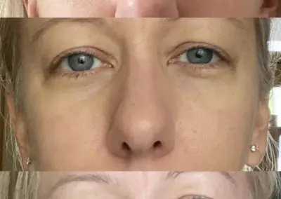 3 photos of a Southern Grace Aesthetics client who received bio-filler/PRP/PRF to address under eye hollowness and "tired" look.