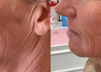 Sculptra used to reduce appearance of lines on the face and neck at Southern Grace Aesthetics in Mount Pleasant