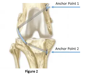 TIghtrope surgery for surgery repair of a torn CCL in dogs