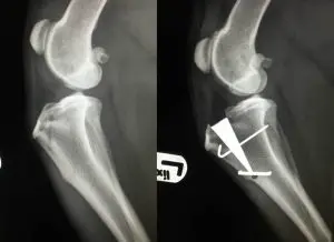 MMP pre and post operative x-rays