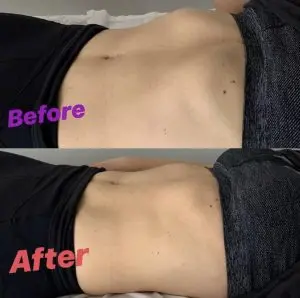 pelvic floor rib photo