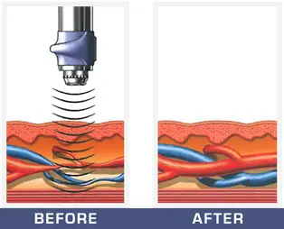 ed treatment before after