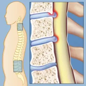 spinal stenosis phoenix