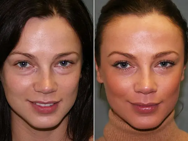 prp facial, platelet rich plasma facial phoenix az