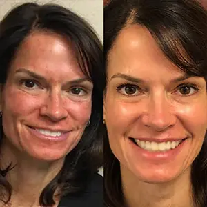 PRP Facial in Phoenix AZ