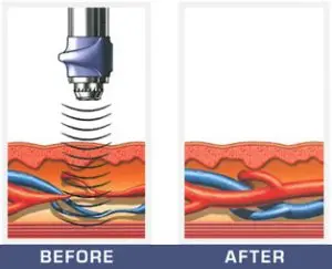 ed treatment before after