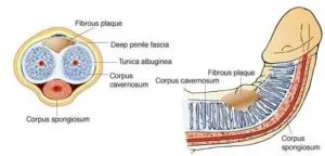 remove plaque from penis with sound wave therapy