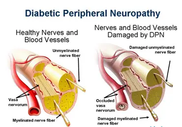 diabetic peripheral neuropathy