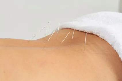 acupuncture for pain