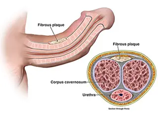 peyronies disease