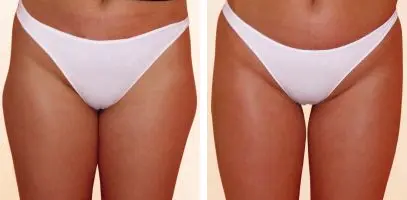 Cellulite treatment before after | Phoenix AZ