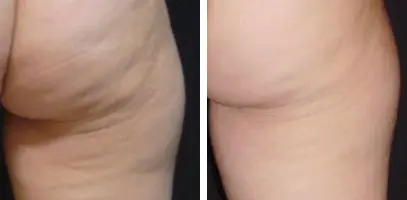 cellulite reduction treatment