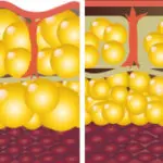 cellulite removal phoenix az