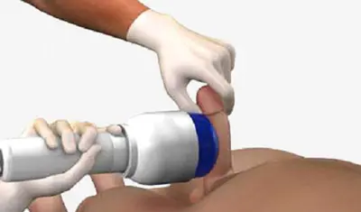 ed treatment Phoenix az