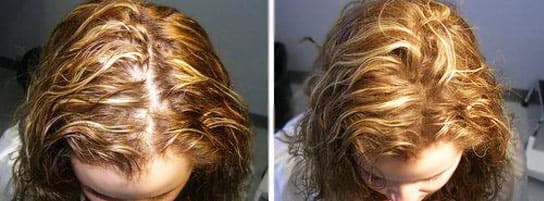hair loss treatment