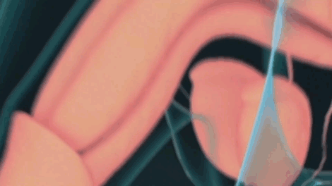 shockwave ed