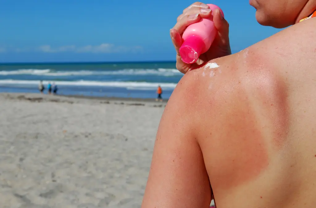 Sunburn