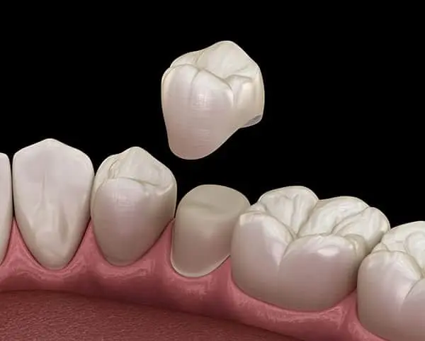 3D image of a dental crown placement