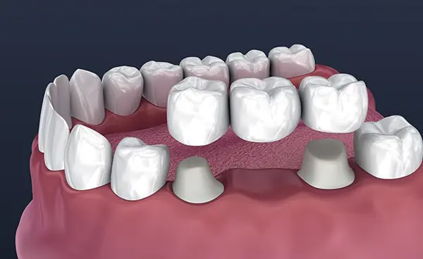 3D image of a dental bridge placement