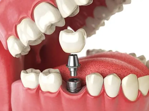 3D Image of the dental implant process