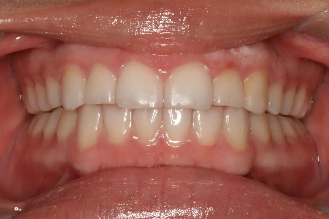 Dental patient after Invisalign treatment