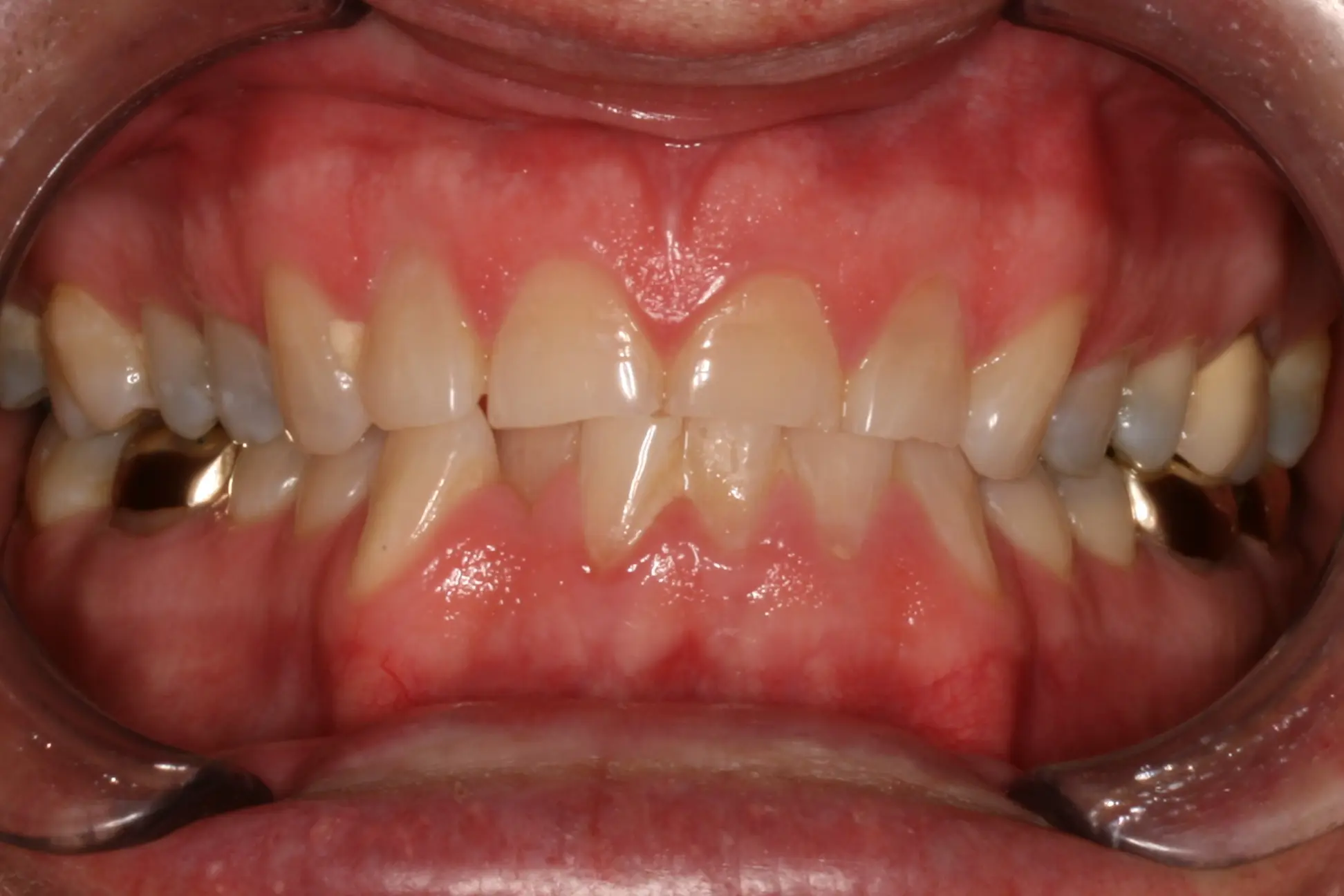 Close up of teeth before using Invisalign in Oakdale, CA