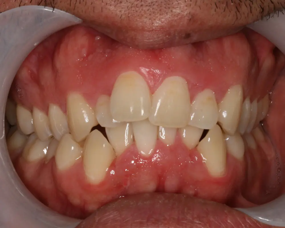 Teeth before using Invisalign in Oakdale, CA