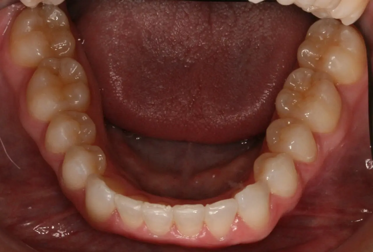 Dental patient after Invisalign treatment
