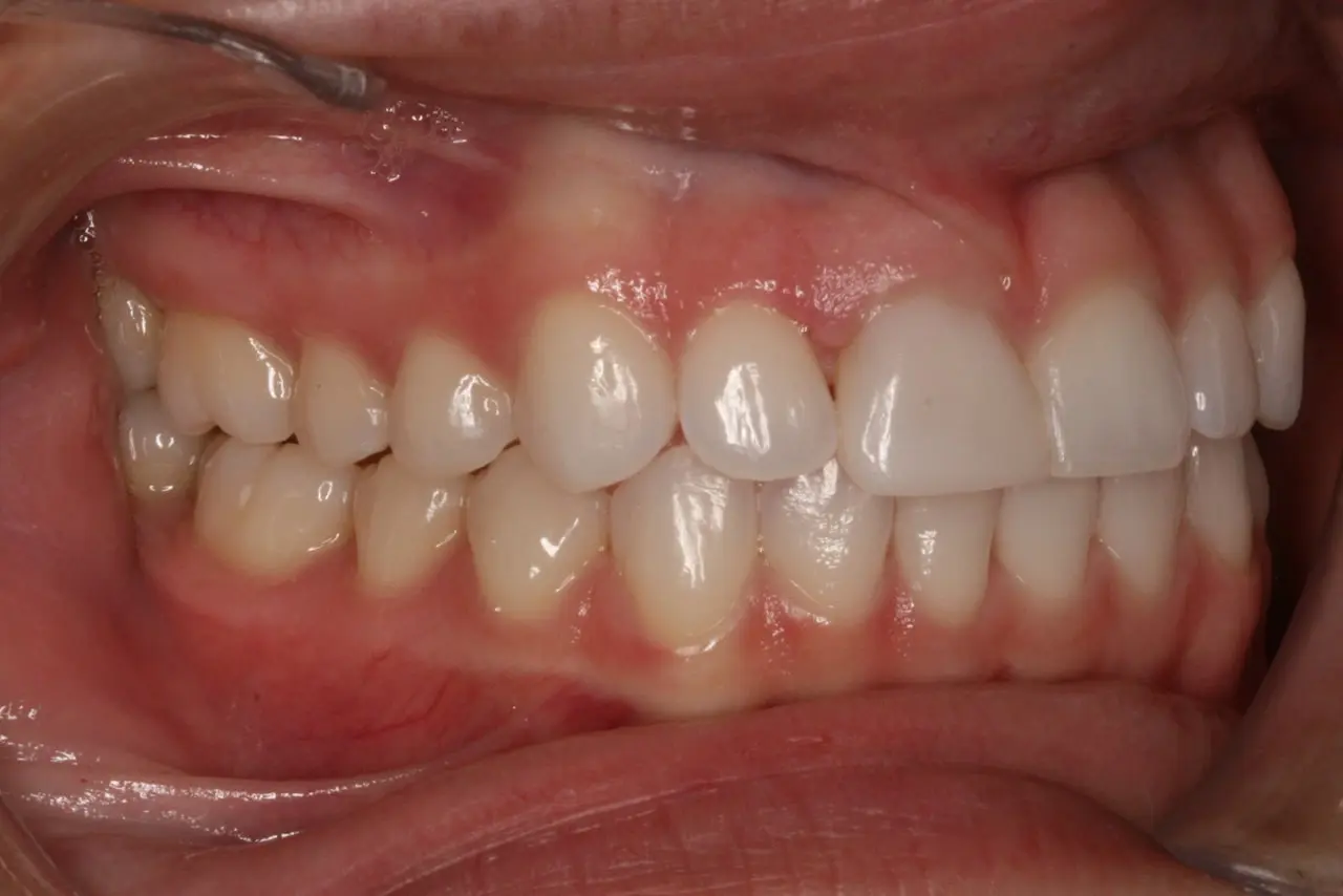 Dental patient after Invisalign treatment in Oakdale, CA