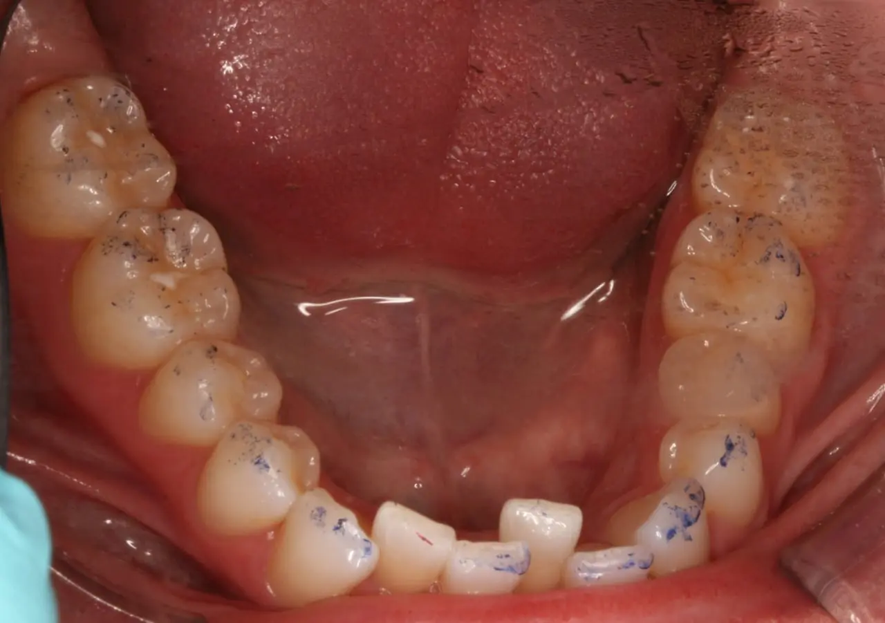 Dental patient before Invisalign treatment