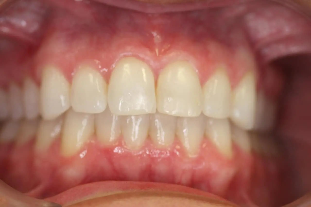 Dental patient after Invisalign treatment