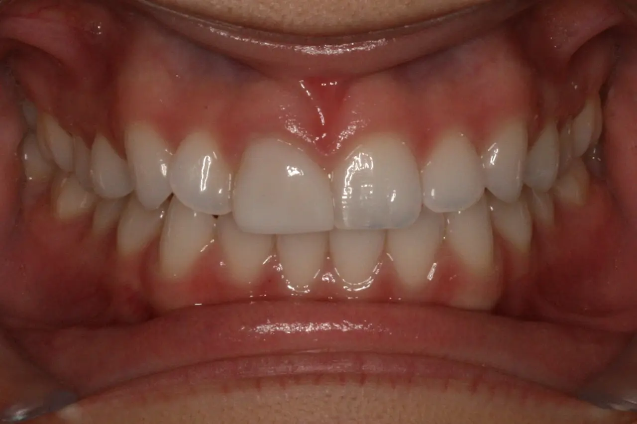 Imperfect teeth alignment before Invisalign treatment