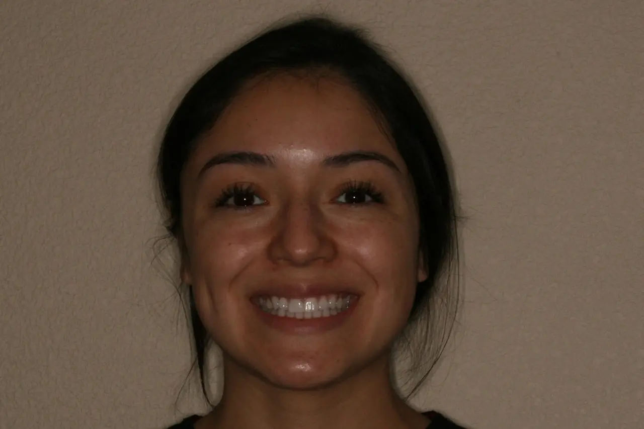 Woman smiling showing her teeth before Invisalign treatment