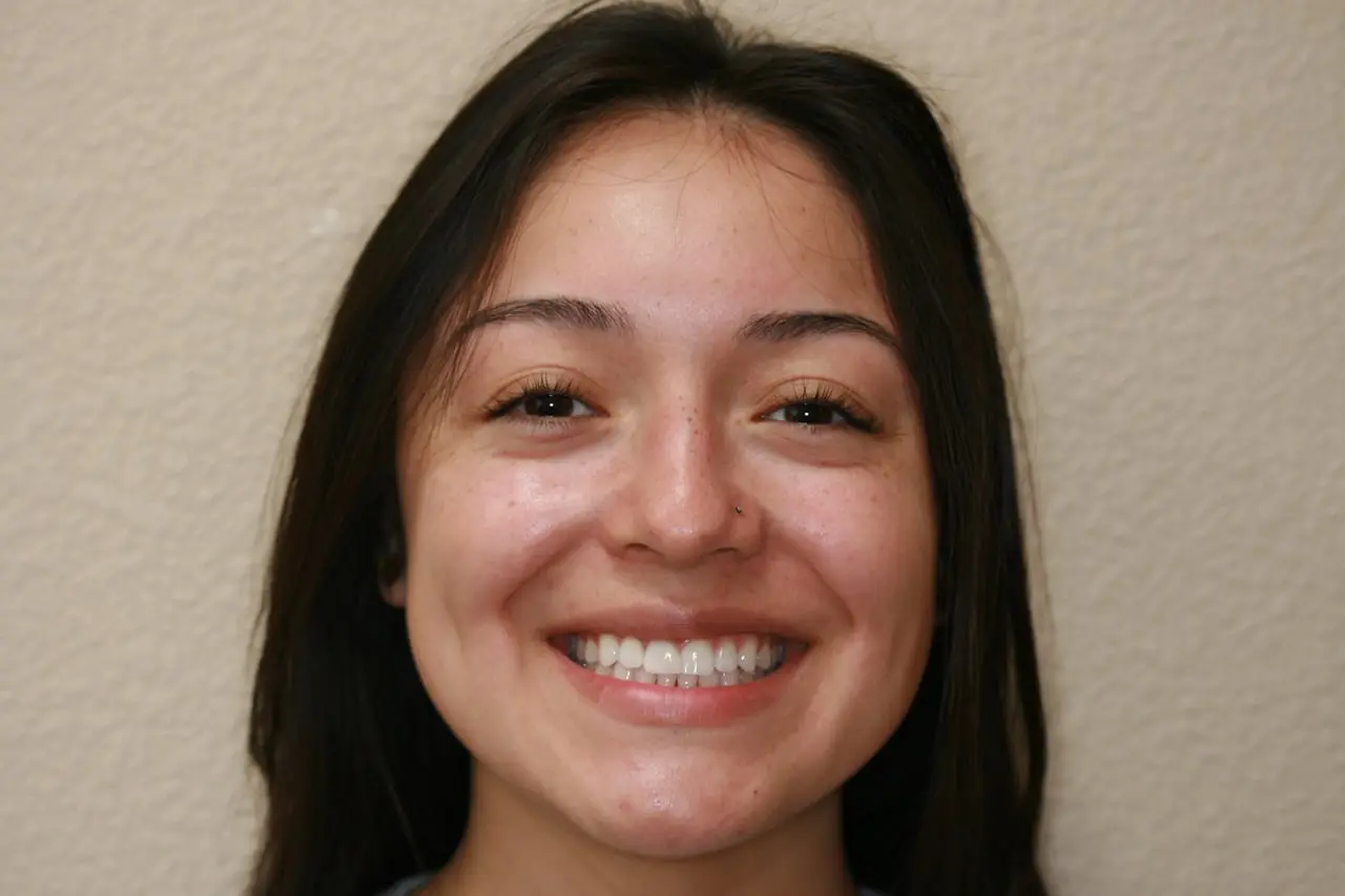 Woman smiling showing her teeth after Invisalign treatment
