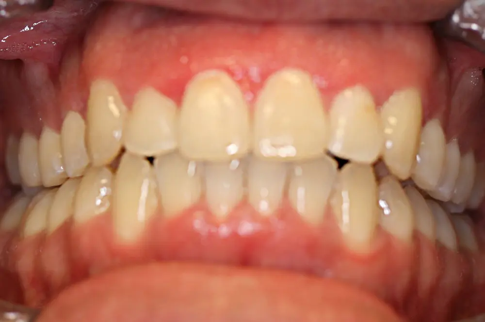 Teeth after using Invisalign in Oakdale, CA