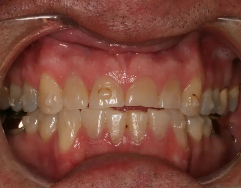 Teeth after using Invisalign, before dental bonding in Oakdale, CA