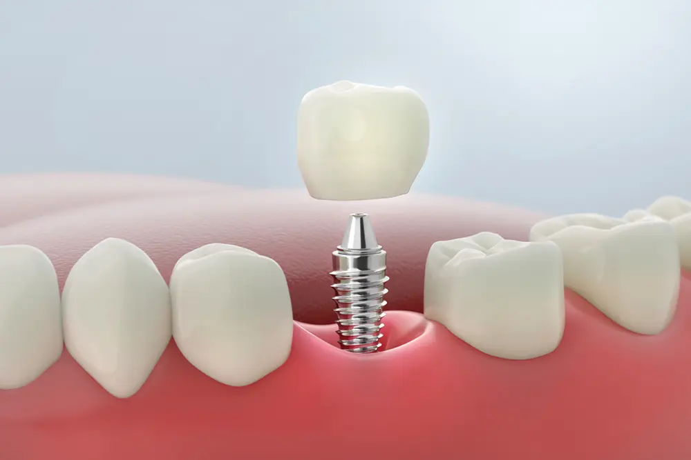 Illustration of a dental implants in Oakdale