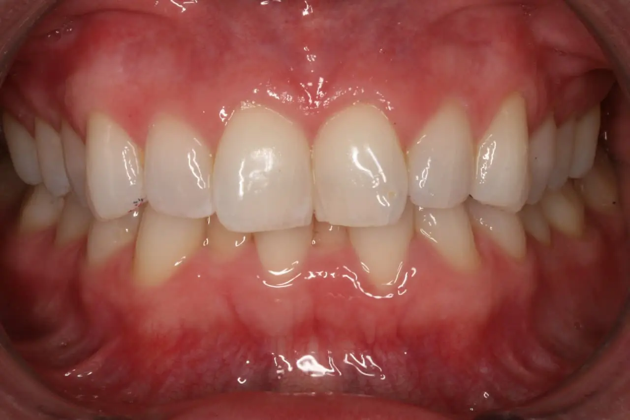 Dental patient before Invisalign treatment