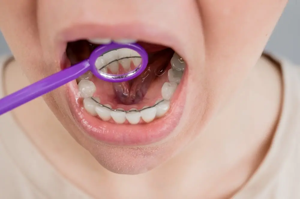 Kid with a custom retainer
