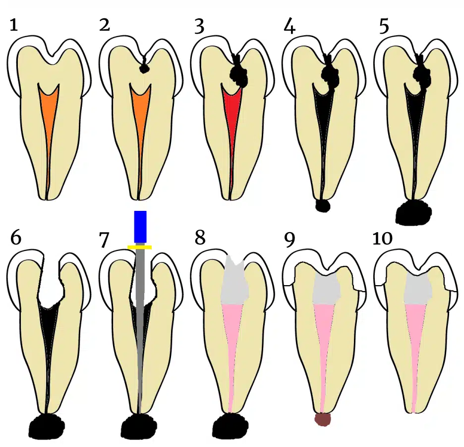 Illustration explaining how a cavity is performed and how a root canal procedure works