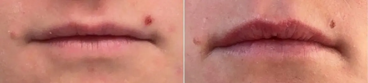 Before and after results of Botox Lip Flip treatment in Boulder, CO