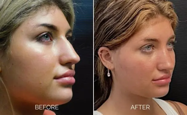 Rhinoplasty before and after right sideview in 45 degrees showing an enhanced nose appearance.