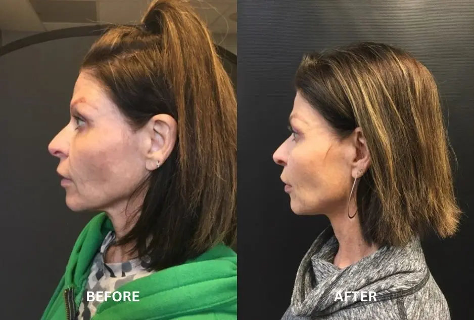 Before and after results of a deep neck lift in Boulder, Colorado